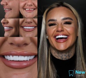 Digital Smile Design Before & After